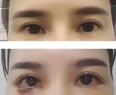 [目]サンクミガール - 目尻切開、グラマラスライン