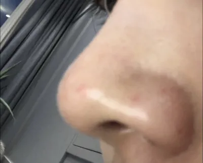 [プチ] ミン_ディ - 鼻の輪郭注射