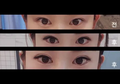 [目] サブリ9999 - 下眼瞼下制術、目尻切開