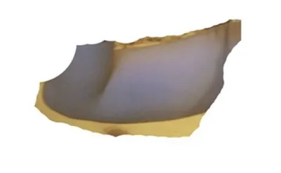 [脂肪吸引] 終わりがない - 脂肪吸引