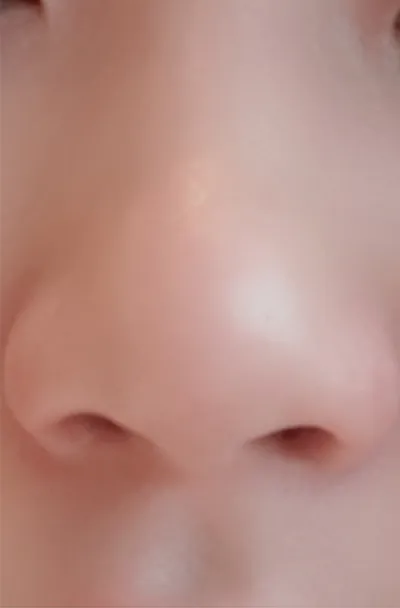 [プチ] 7時11分 - 鼻の輪郭注射