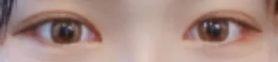 [目] 目尻切開しました - 目