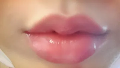 【プチ】チョンドゥン2 - 唇フィラー