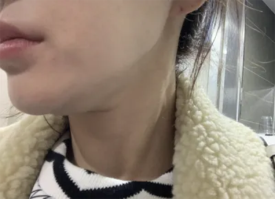 [プチ] ルドルフオモニ - ボトックス、輪郭注射