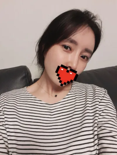 [アンチエイジング] ㅅㄴㄷㄴㅅㅊ - 目、脂肪移植