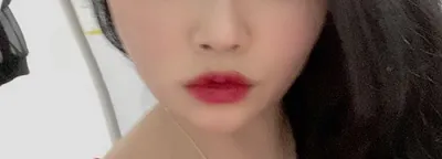 [皮膚] sソヨンs - ウルセラ、シャネル注射