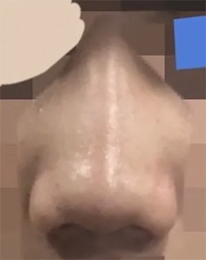 [鼻] ガナ手術 - 鼻