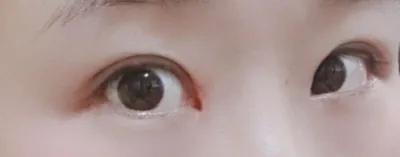 [目] ピングチン - 目つき矯正、切開