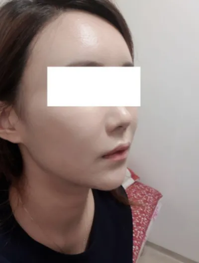 [アンチエイジング] カロンイ - フルフェイス脂肪移植