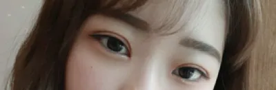 [目] msdmsquf2 - 埋没法、目頭切開