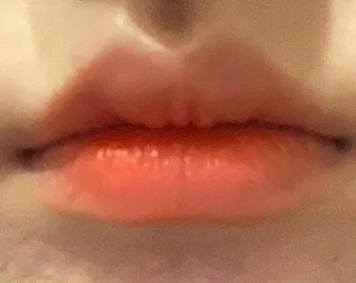 [쁘띠] ラプンツェル@ - 唇フィラー