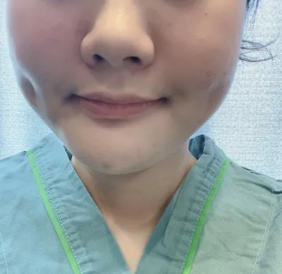 [脂肪吸引] kimy226 - 顔の脂肪吸引