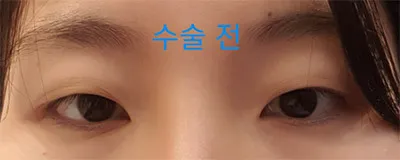 [目] まっすぐ噴射式 - 目