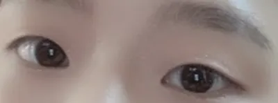 [目] イ・ス - 埋没法、目頭切開