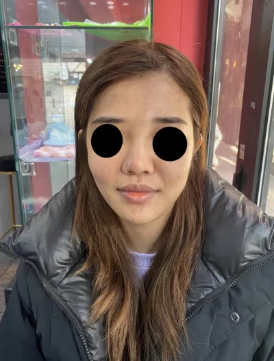 [アンチエイジング] ppkim0119 - 脂肪移植