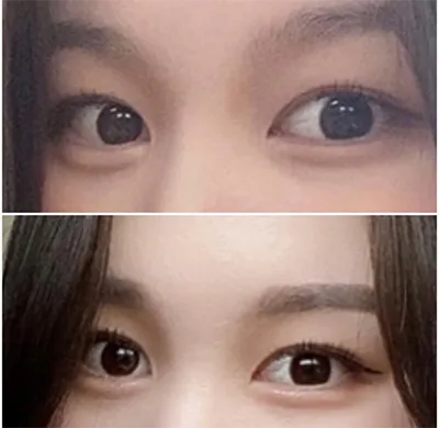 [目] ヨンドゥドゥ - 二重、切開