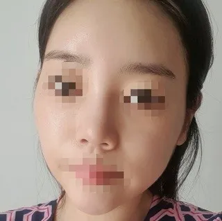 [鼻] ピンク色 - 鼻、輪郭