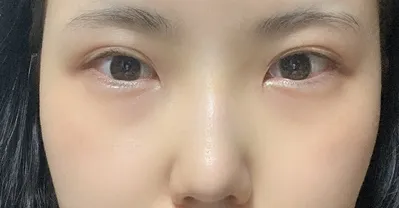 [目] 怒った - 目、鼻