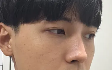 [鼻] 一ヶ月 - 鼻、輪郭