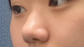 [鼻] ビッカブ - 鼻、頬骨