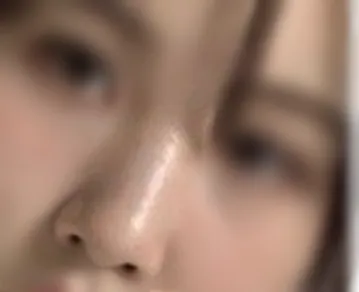 [鼻] 鼻の整形 - 鼻