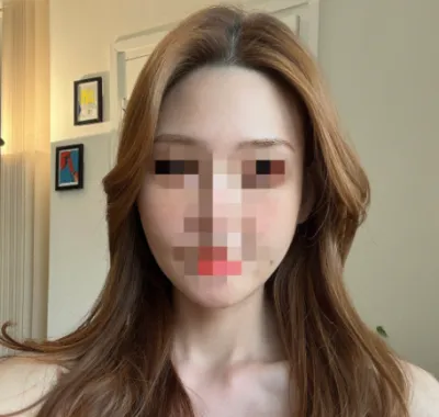 [輪郭手術] ラビューv2 - 顔面輪郭