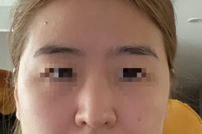 [鼻]ミョンジス - 鼻、脂肪移植