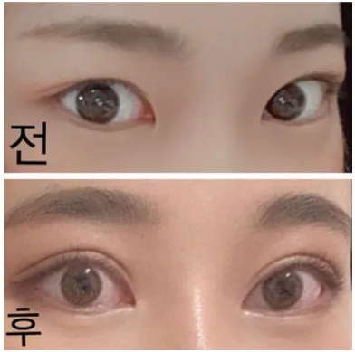 [目] ホホバ - 目、鼻、額リフト