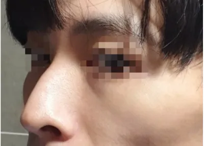 [鼻] ハルサリ - 鼻