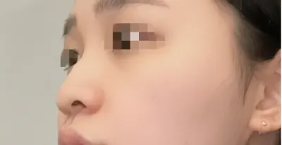 [鼻] コンプレックス解消 - 鼻