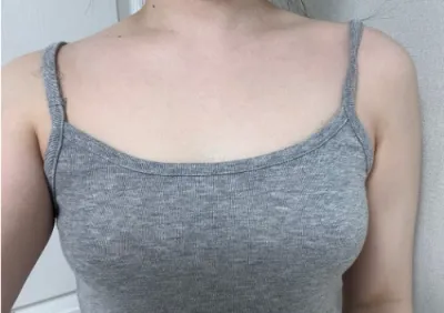 [豊胸] 炭酸 - 胸