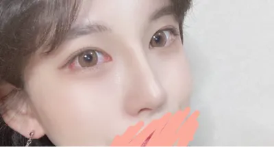 [鼻] 遊ぶのが一番好き - 目、鼻、額リフト