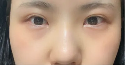 [目] ププンイ - 目、鼻