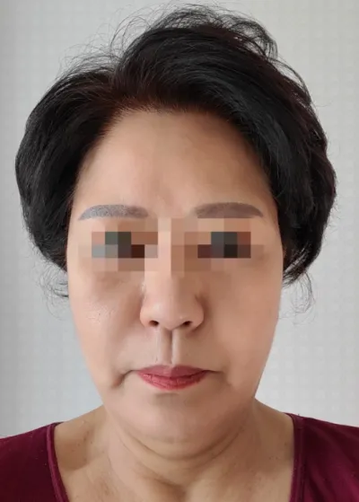 [アンチエイジング] アカシア - フェイスリフト手術