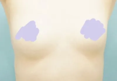 [豊胸] オーシャンプラムザブルー - 豊胸