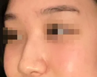 [鼻] 風邪に注意 - 鼻