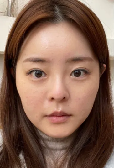 [鼻] ミンアミンオ - 目、鼻、顔の脂肪吸引