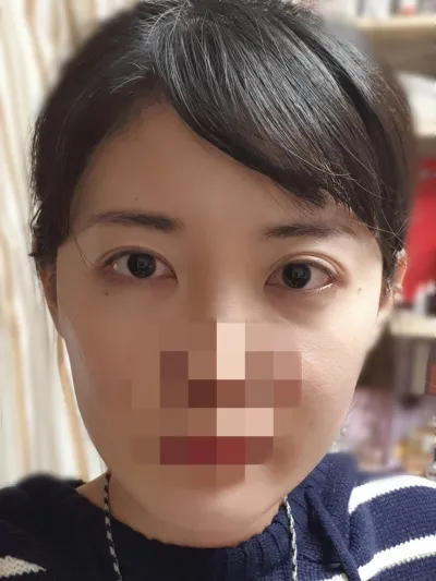 [輪郭手術] 女神のよう - 輪郭、目