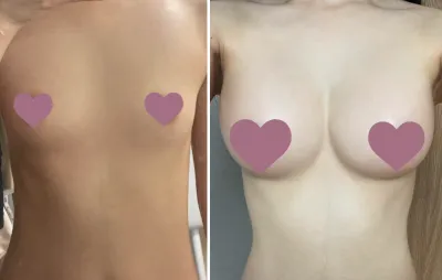 [豊胸] ひっくり返せアッパーカット - 胸