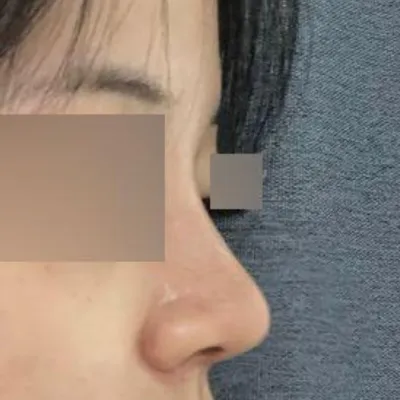 ウィーバース美容外科 鼻手術 1ヶ月目