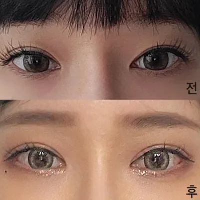 目の再手術をしてからもう2ヶ月くらい経ちましたㅎ