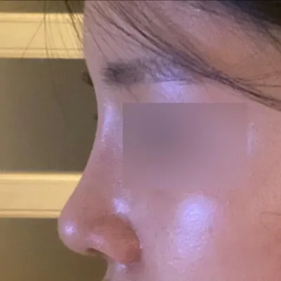 ソ・スンジョ院長に手術を受けて1ヶ月後のレビューです