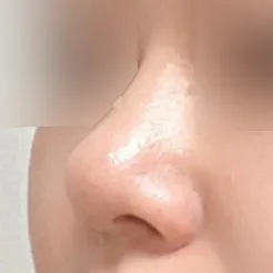 プロテーゼなしの団子鼻改善手術のレビュー