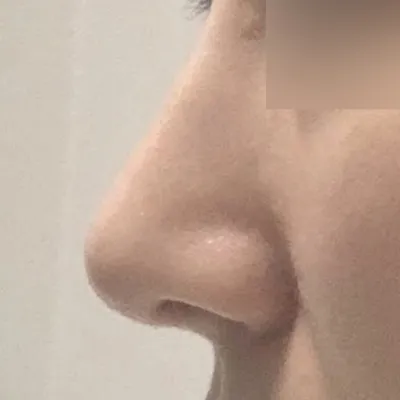 鼻の手術をしてからほぼ4ヶ月になります