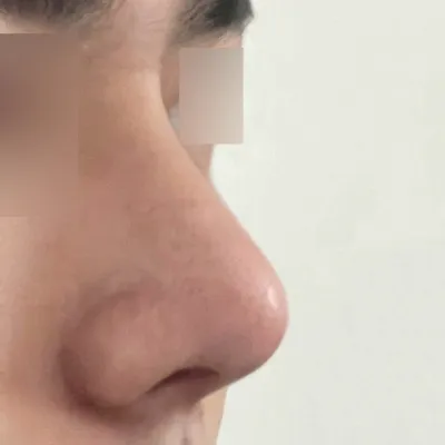 シム・ジョンファン院長に手術を受けてから1ヶ月になりました。