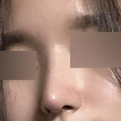 直線的なラインで手術して2ヶ月になりました