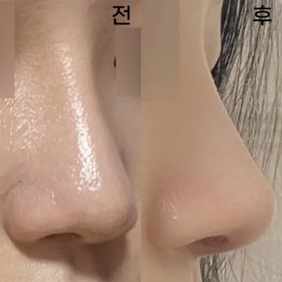 代表院長先生に鼻の再手術を受けてから早くも1ヶ月です