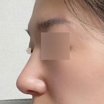 プロテーゼなしでハンプ切除手術を受けました！