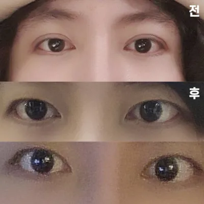 二重ライン修正手術後の経過