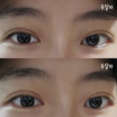 二重手術から2ヶ月後のリアルなレビューです～^^